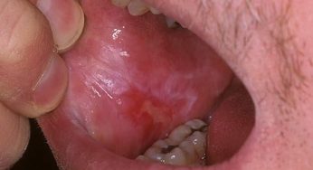Lichen Planus Rongga Mulut dan Kaitannya dengan Stres