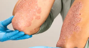 Memahami Psoriasis: Gejala, Penyebab, dan Pengobatan