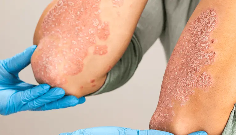 psoriasis