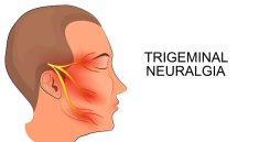 trigeminal neuralgia