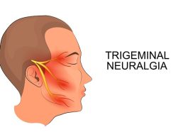 trigeminal neuralgia