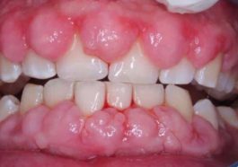 hiperplasia gingiva