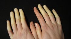 sindrom raynaud