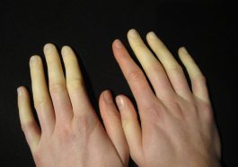 sindrom raynaud