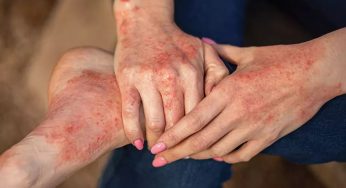 Dermatitis Atopik (Eksim): Ketika Kulit Menjadi Sensitif