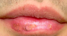 cheilitis aktinik
