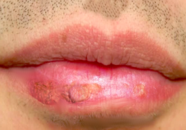 cheilitis aktinik
