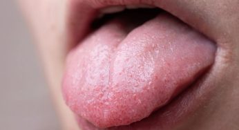 Makroglosia: Ketika Lidah Membesar Tidak Normal