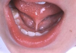 neuralgia sublingual