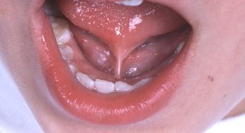 Neuralgia Sublingual: Nyeri Saraf yang Jarang Tapi Mengganggu