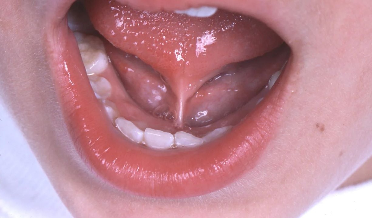 neuralgia sublingual