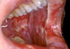 oral mucositis