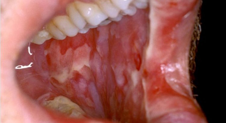 oral mucositis