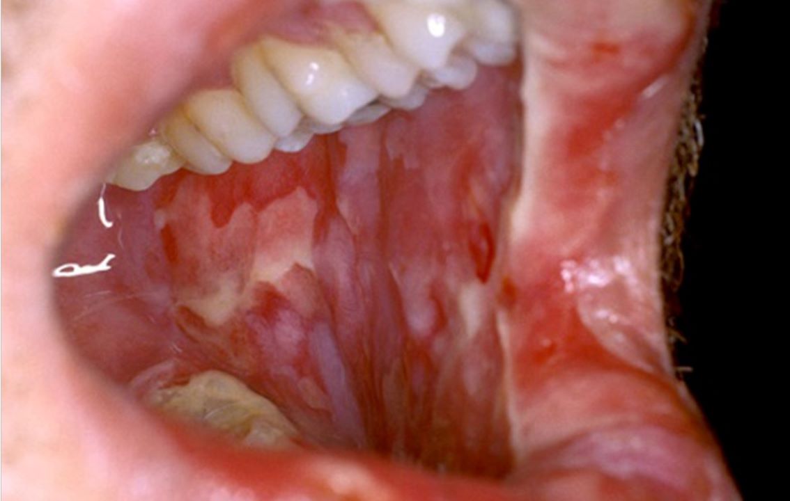 oral mucositis