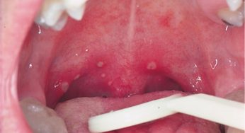 Mengenal Herpangina, Infeksi Virus yang Menyerang Anak-Anak