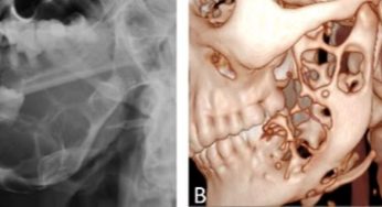 Ameloblastoma: Tumor Jinak Rahang yang Perlu Diwaspadai