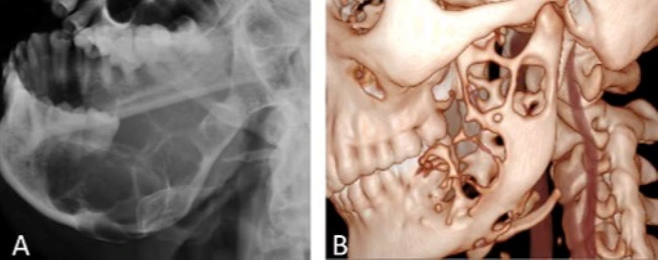 ameloblastoma