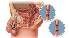 kontrasepsi permanen
