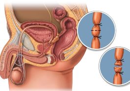 kontrasepsi permanen