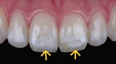 fluorosis gigi