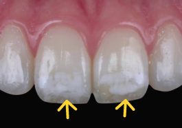 fluorosis gigi