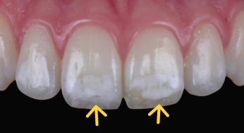 Fluorosis Gigi: Kondisi Akibat Kelebihan Fluoride