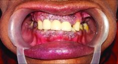 cobblestone appearance