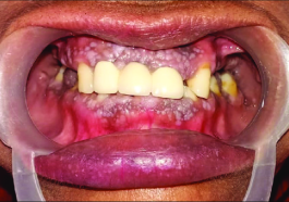 cobblestone appearance