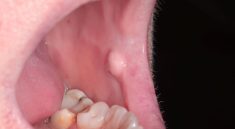fibroma oral