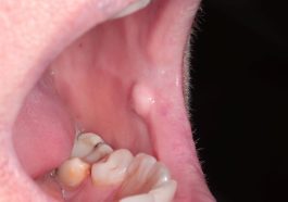 fibroma oral