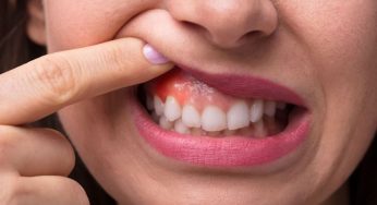 Memahami Dental Granuloma, Apakah Itu?