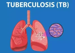 tuberkulosis