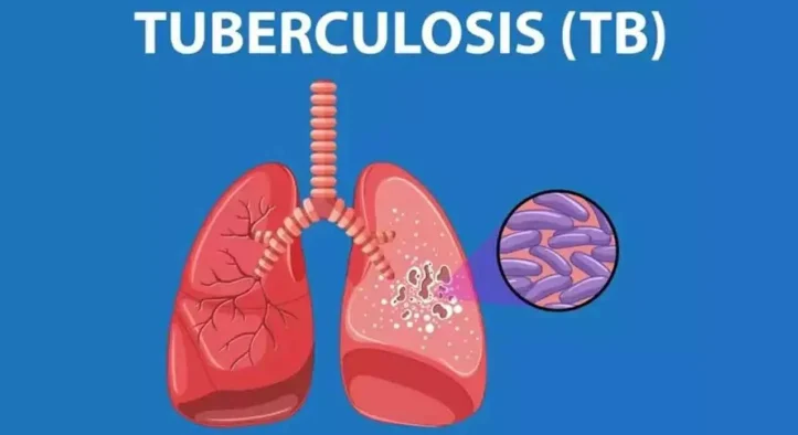 Tuberkulosis (TBC) Tewaskan 2 Orang Tiap 5 Menit, Waspada!