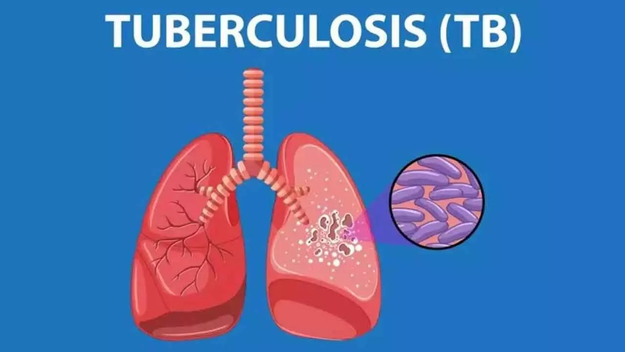 tuberkulosis