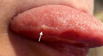 Kenali Papillitis: Peradangan pada Papila Lidah