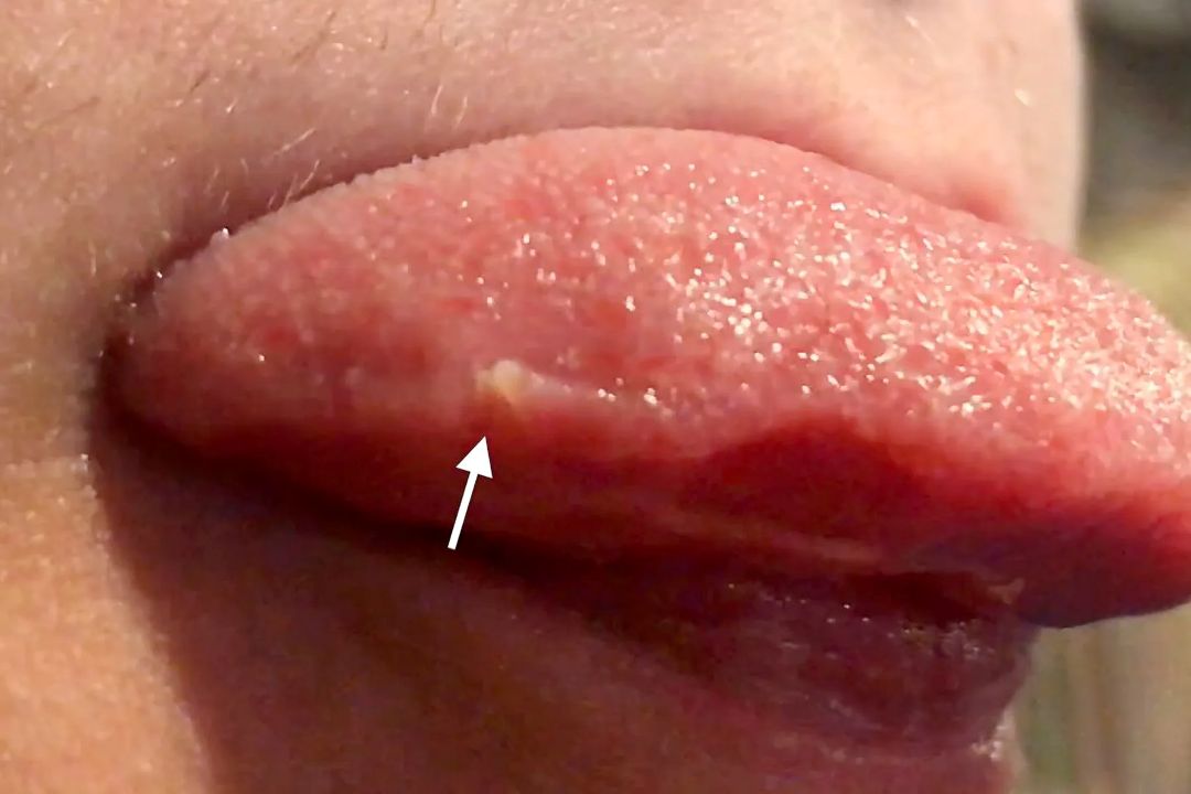 papillitis