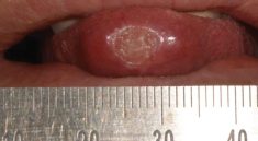 tuberkulosis oral
