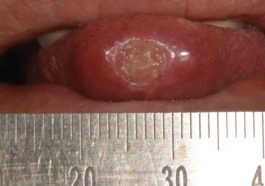 tuberkulosis oral