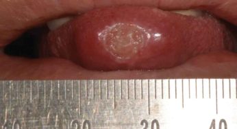 Tuberkulosis Oral: Manifestasi Langka yang Perlu Diwaspadai