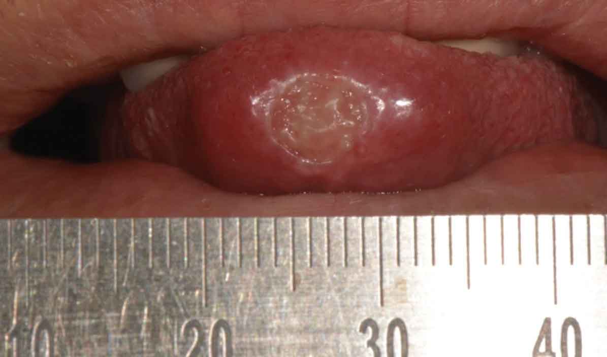 tuberkulosis oral