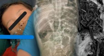 Kasus Balita Meninggal karena Cacingan, Dokter Ingatkan Bahaya dan Pencegahan