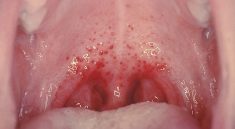 petechiae di rongga mulut