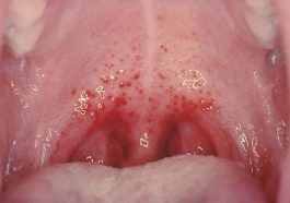 petechiae di rongga mulut