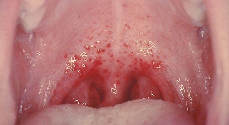 petechiae di rongga mulut