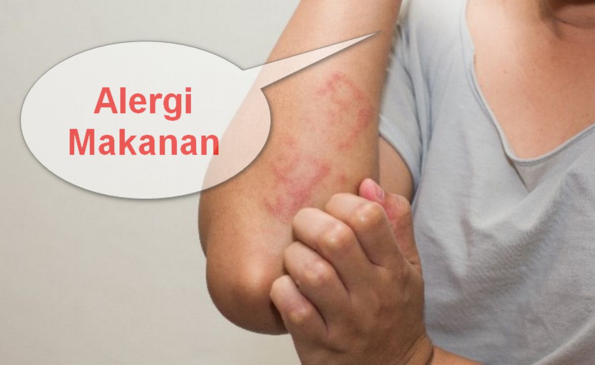 alergi makanan